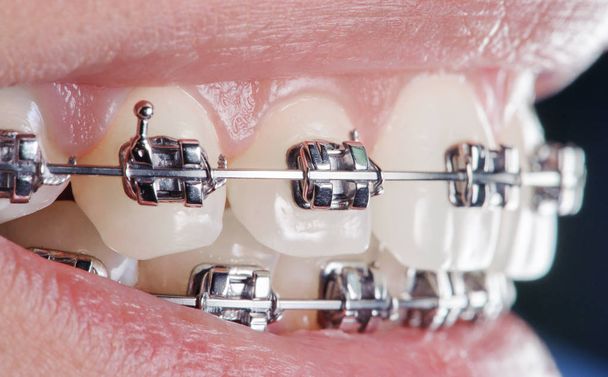 Braçadeiras dentárias de perto nos dentes. Tratamento Ortodôntico
 - Foto, Imagem