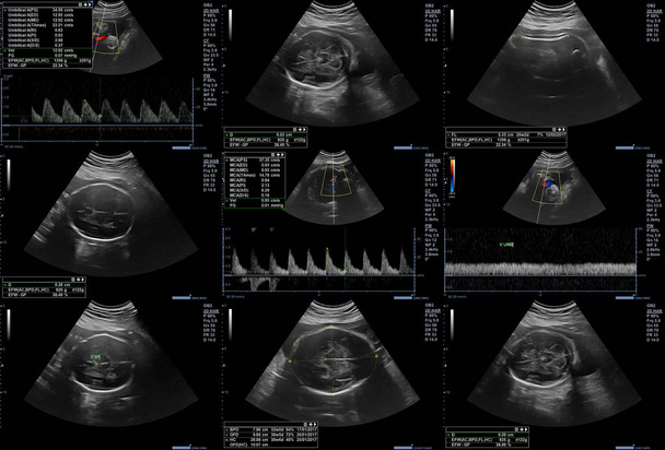 Ultraschall-Bilder des Fötus - Foto, Bild