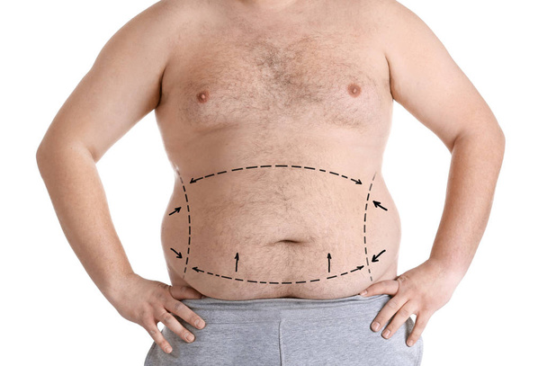  Man with marked fat problem - Photo, image