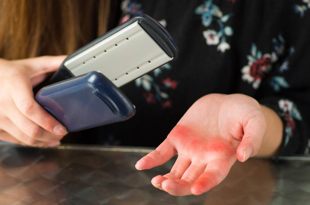 Yakın, bir kadın ütü saçlarını kullanarak eli yandı - Fotoğraf, Görsel