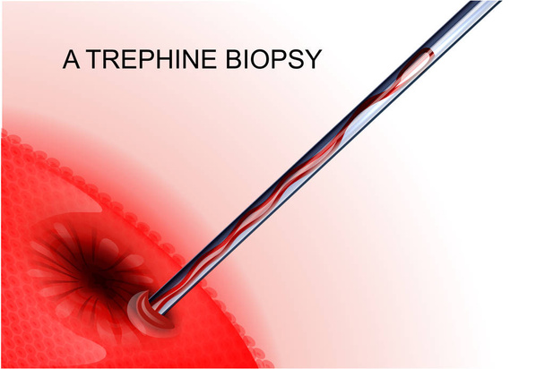 trephine biopsie kanker tumor - Vector, afbeelding