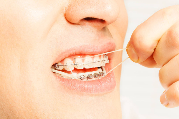 чоловічий рот з ортодонтичними брекетами
 - Фото, зображення