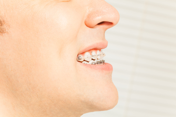 брекети на зубах у перегляді профілю
 - Фото, зображення