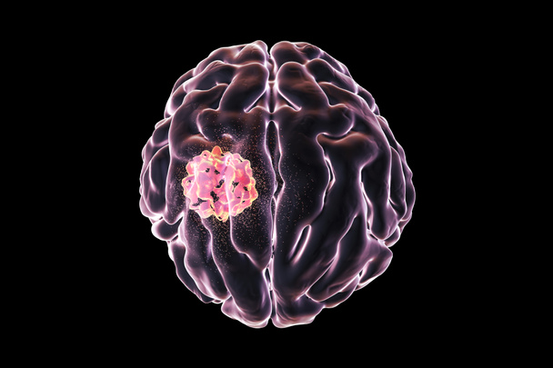 Destruction of brain tumor - Photo, Image