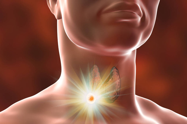 Destruction of thyroid tumor - Photo, Image
