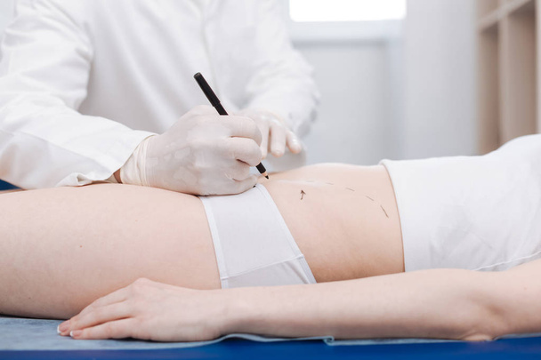 doctor preparing patients belly for liposuction - Foto, afbeelding
