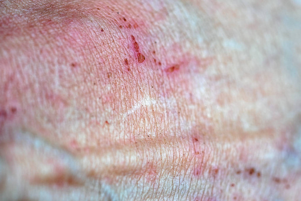 ošklivá nemoc kůže textury Detailní záběr - Fotografie, Obrázek