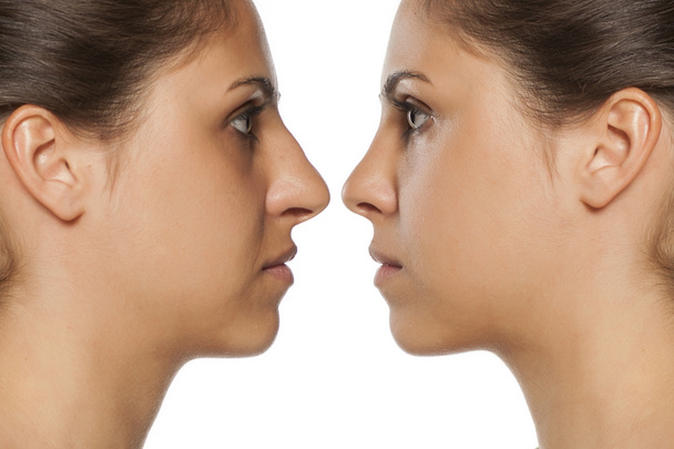 operace nosu před a po - Fotografie, Obrázek