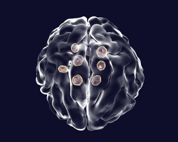 Cistos criptocócicos múltiplos no cérebro
 - Foto, Imagem
