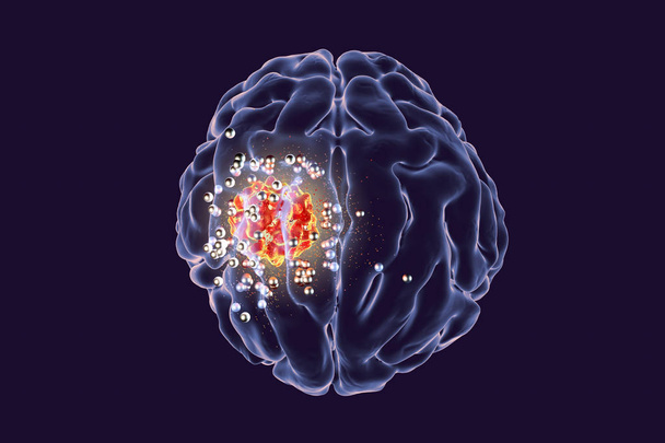 A nanorészecskék agydaganat megsemmisítése - Fotó, kép