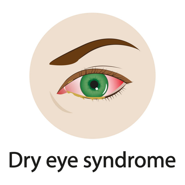 Syndrome des yeux secs. Illustration vectorielle. - Vecteur, image