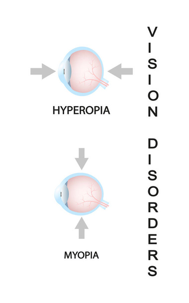 Міопія та міопія виправляються мінус-лінзою. Розлад зору очей
. - Вектор, зображення