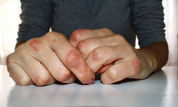Psoriaasi käsissä. Psoriaasin tai ekseeman aiheuttama sormien punoitus ja ärsytys
 - Valokuva, kuva