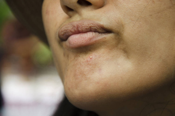Acne or pimple obstruction on chin of thai women - Photo, Image