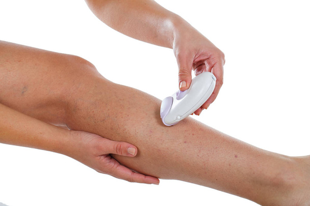 Varicose veins on woman's leg & epilator - Foto, imagen