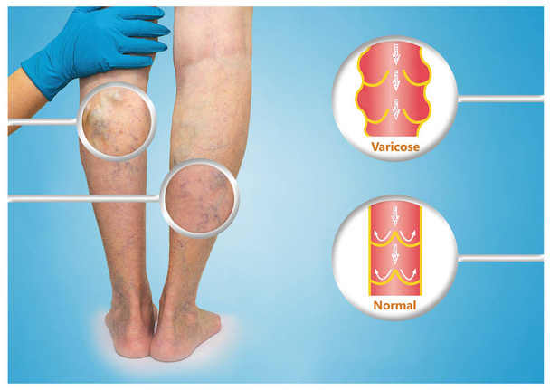 Vene varicose su una gamba anziana femminile
 - Foto, immagini