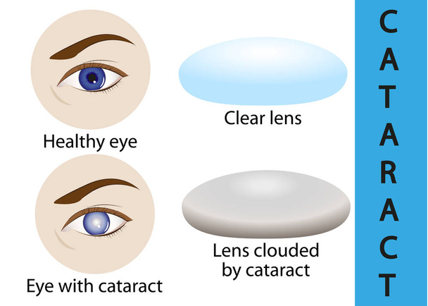 Una catarata es una lente cristalina nublada dentro del ojo
. - Vector, Imagen