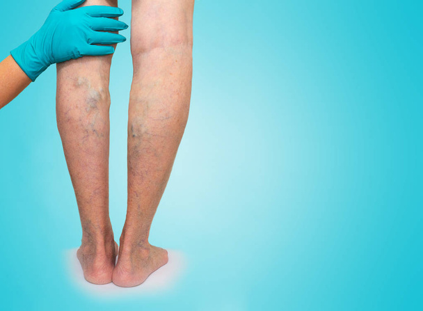 Close-up of skin with varicose veins on senior male leg. Concept