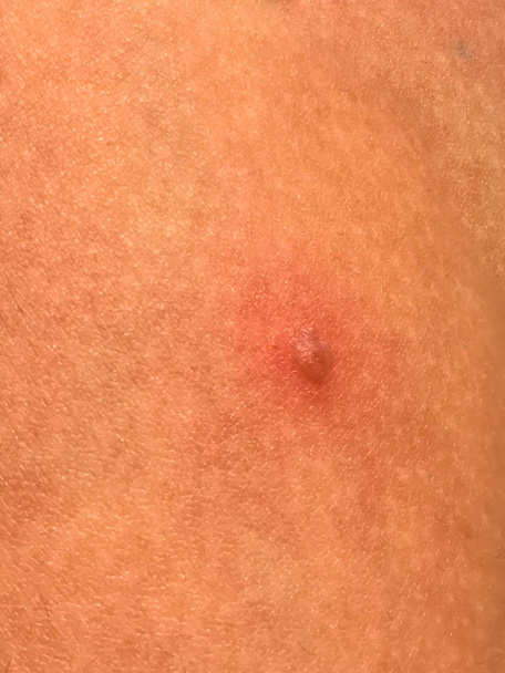 Chickenpox on skin of the child - Photo, Image