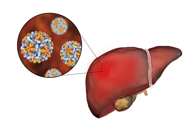 Hígado con infección por Hepatitis B y vista de cerca del virus de la Hepatitis B
 - Foto, imagen