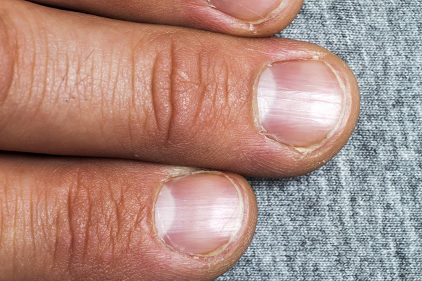 Mens fingers and nails in bad condition close up - Photo, Image