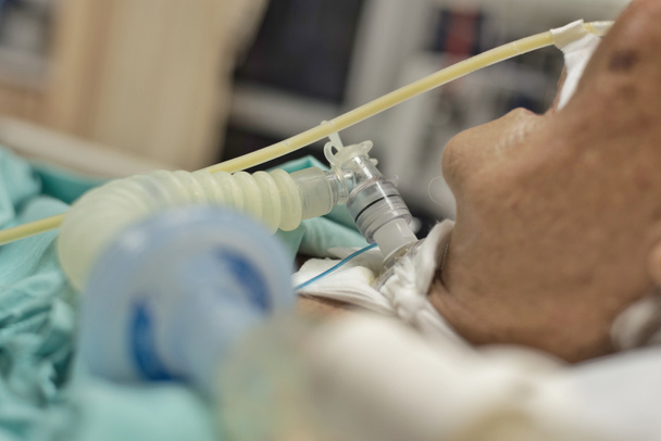 Le patient fait une trachéostomie et un ventilateur à l'hôpital
 - Photo, image