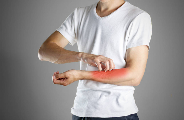 Guy in white shirt scratching his arm. Scabies. Scratch the hand - Foto, Imagem
