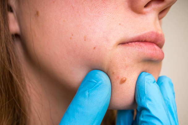 Woman with birthmark on her face, skin tags removal - Photo, Image