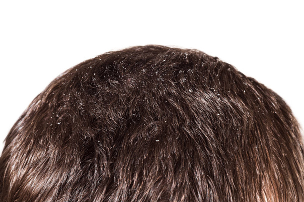 Dandruff on male dark hair on a white background - Foto, imagen