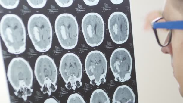 Neurochirurg doktor dívá na snímek magnetická rezonance mozku - Záběry, video
