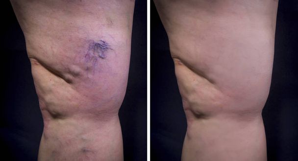 Human leg with varicose veins - Photo, Image