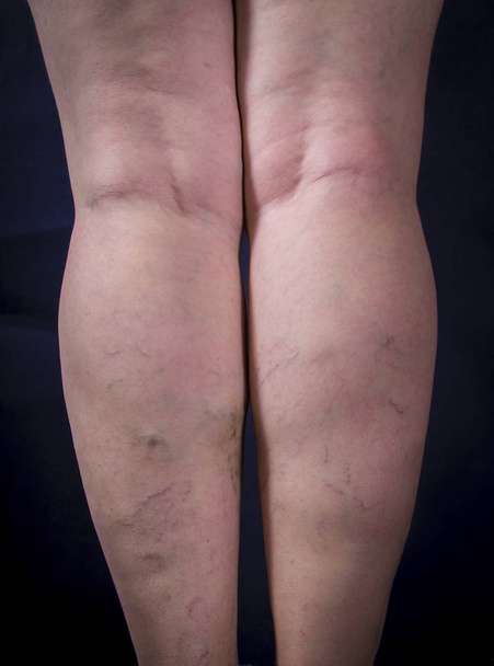 Human legs with varicose veins - Photo, Image
