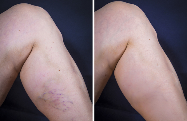 Pierna humana con varices antes y después del tratamiento
 - Foto, Imagen