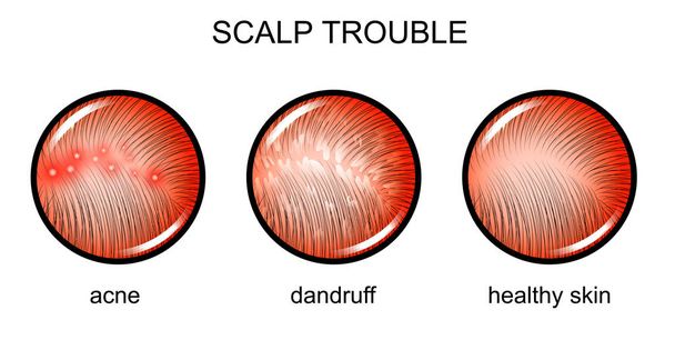 troubled scalp. dermatology - Vector, Image