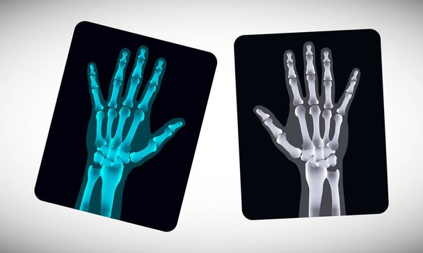 Radiography. Picture of human hands on the film. Vector - Vector, Image