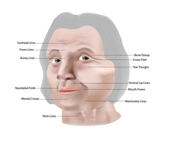 Tipos de arrugas faciales. Ilustración vectorial
 - Vector, imagen