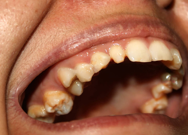 Kromme tanden. Orthodontie. Onderontwikkeling en gebreken van tanden. - Foto, afbeelding