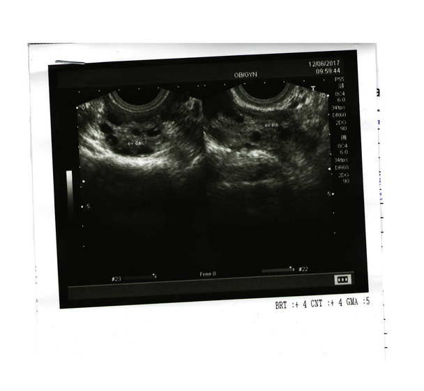 Ultrasound picture of ovaries. - Photo, Image