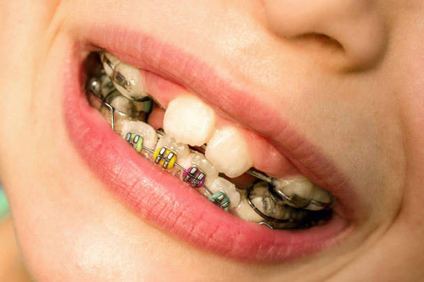 Metalen beugels in de mond van het kind. Tandheelkundige zorg. Glimlach met ortodon - Foto, afbeelding