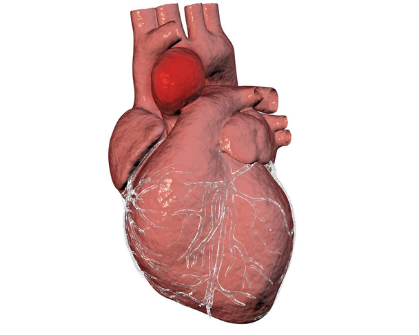 Aneurism of ascending aorta - Photo, Image