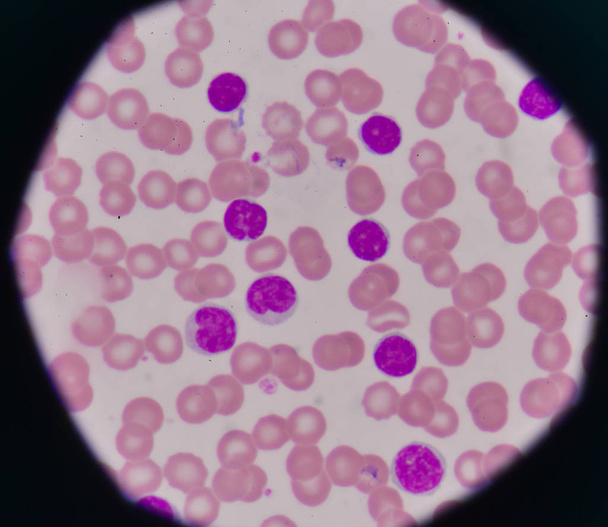 CLL blood smear - Photo, Image