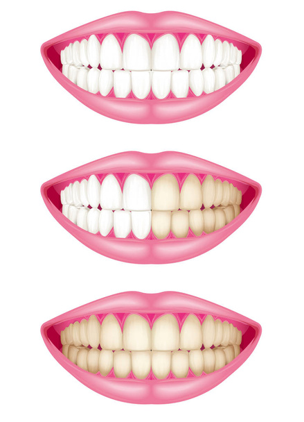 Staining of teeth. Plaque. - Vector, Image