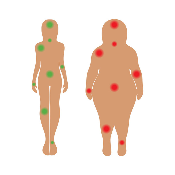 The body of a woman with pain points. Medicine and health - Vector, Image