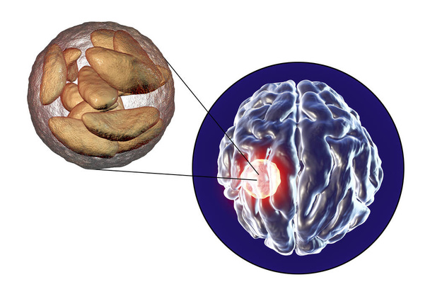 Paraziter protozoon Toxoplasma gondii tarafından neden beyin apsesi - Fotoğraf, Görsel