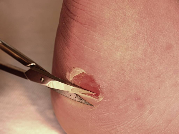 Małe nożyczki gięte cięcia skóry pęknięty blister na pięcie człowieka. Bolesne miejsce z otarcia skóry, - Zdjęcie, obraz