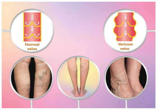 Varicose veins on a female senior leg - Photo, Image