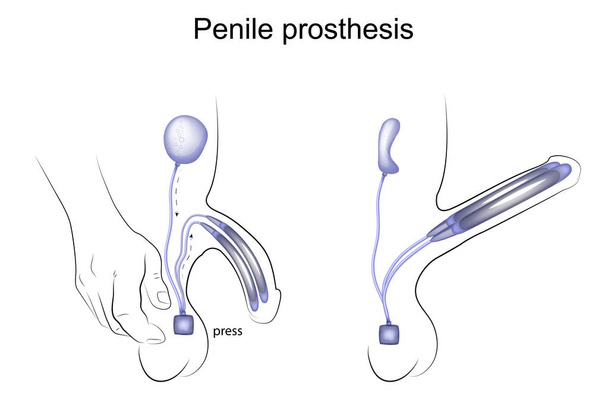 Penisprothese. Urologie - Vektor, Bild