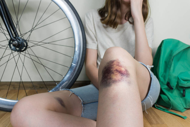 Young woman in casual street style clothes with bruised knee rests after bicycle accident - Foto, Imagem