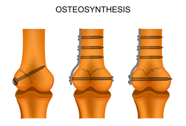 a combcsont osteosynthesishez - Vektor, kép