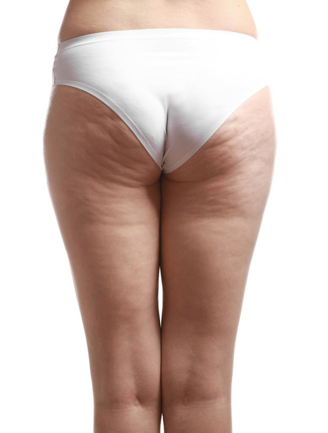 Woman with cellulite problem - 写真・画像
